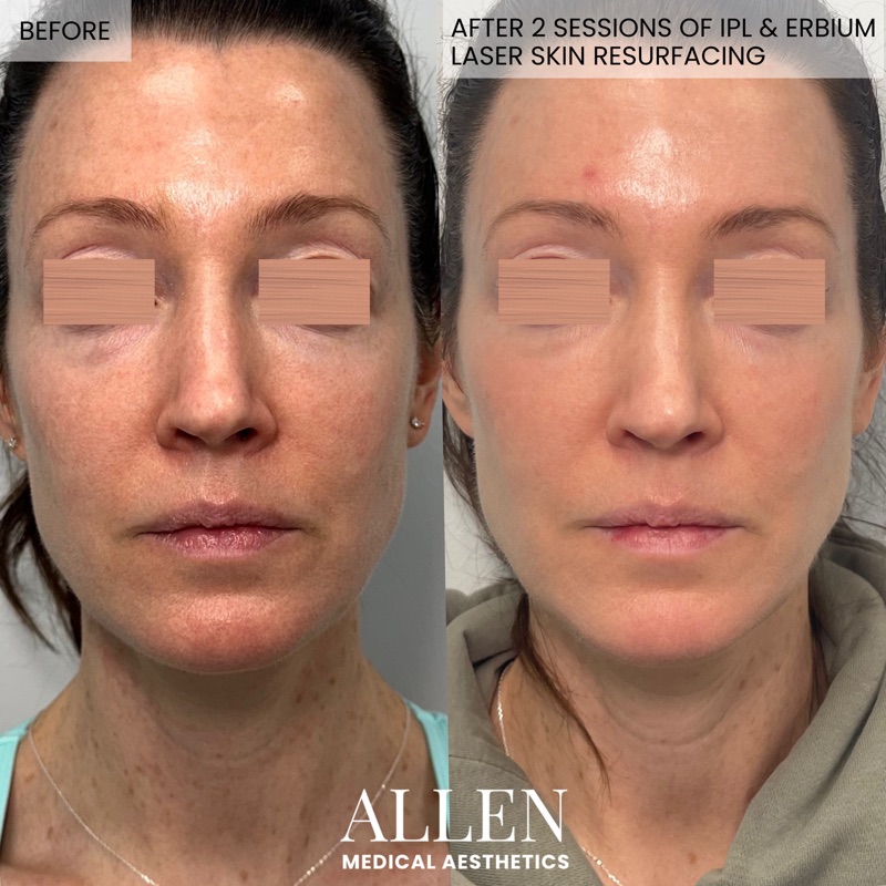 Before and after IPL and Erbium laser for skin renewal